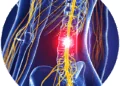 Symptoms of a Herniated Disc and How It Can Lead to Spinal Cord Damage