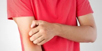 How to Identify and Prevent Ringworm and Eczema?